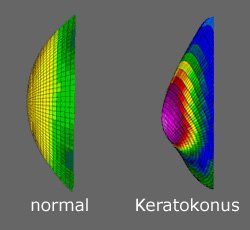 Keratokonu Keratograf
